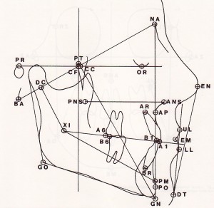 Cephalometric Analysisi - Ricketts Points and Planes