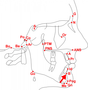 Chepalometric Analysis - B-point (Point B, Supramentale, sm)