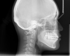 cephalometric analysis orthognathic surgery