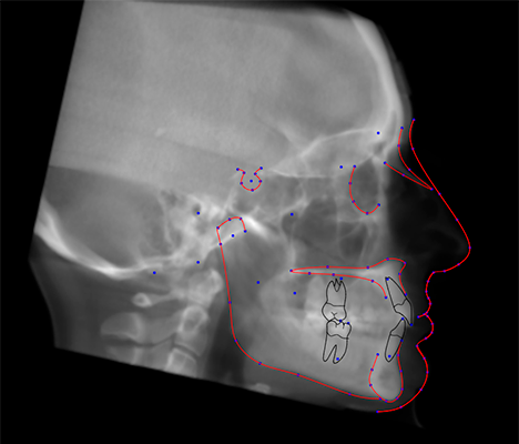 CephX-Cephalometric-Analysis-from-CBCT