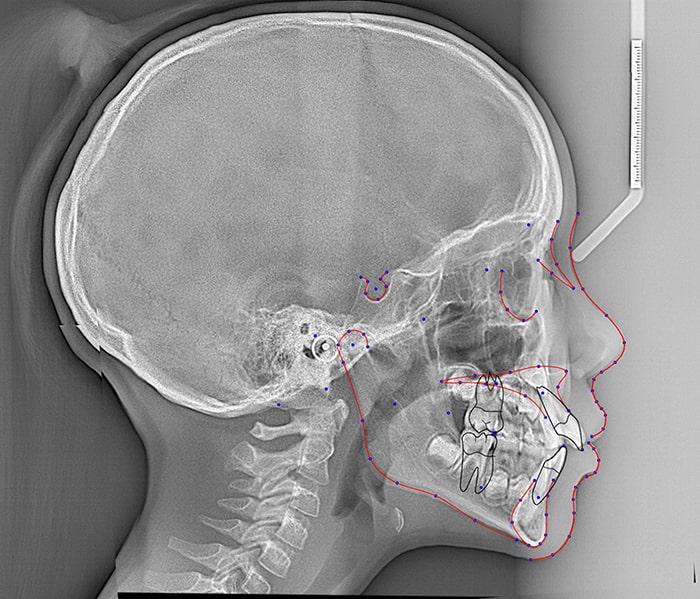 CephX-Cephalometric-Analysis-from-xray