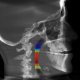 Airway Volume Analysis