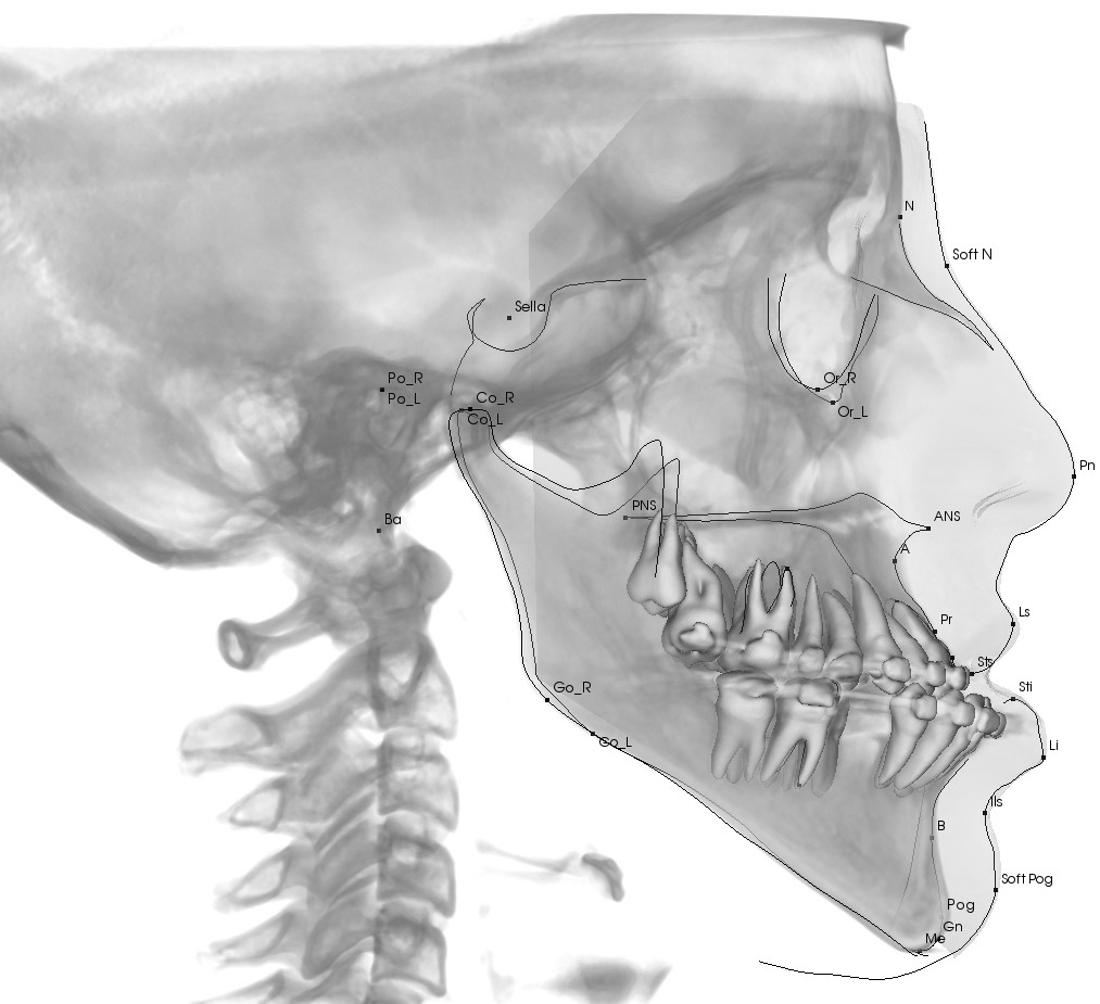 Rikets_BW_SQ - 3d cephalometric analysis